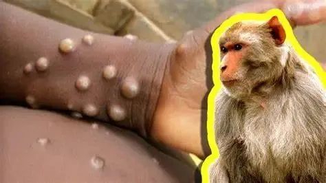病毒性人畜共患病 ，天花疫苗对猴痘有效。